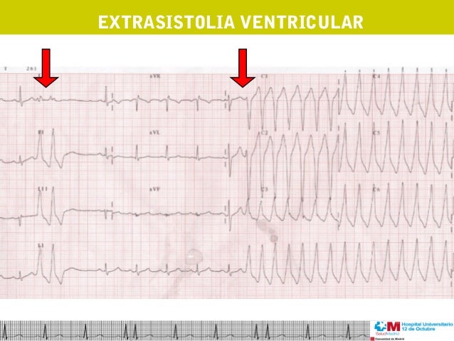 extrasistolia ventricular